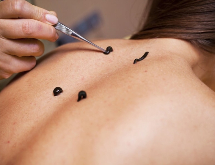 Гирудотерапия - Оздоровительные услуги - Санаторий «Киев» Алушта